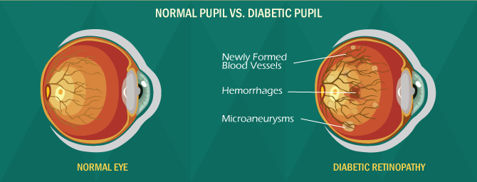   Normal Eye VS. Diabetic Pupil