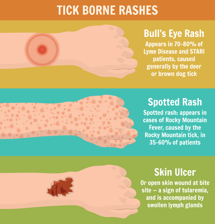 Tick Bites – Pictures, On Humans , Symptoms, Treatment